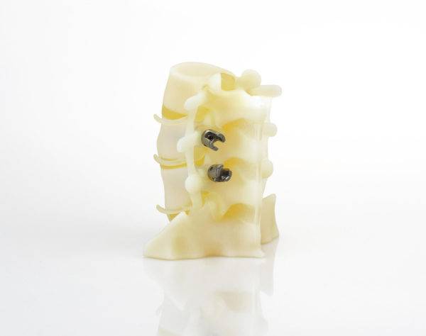 Spine Implants 1 - BioMimics